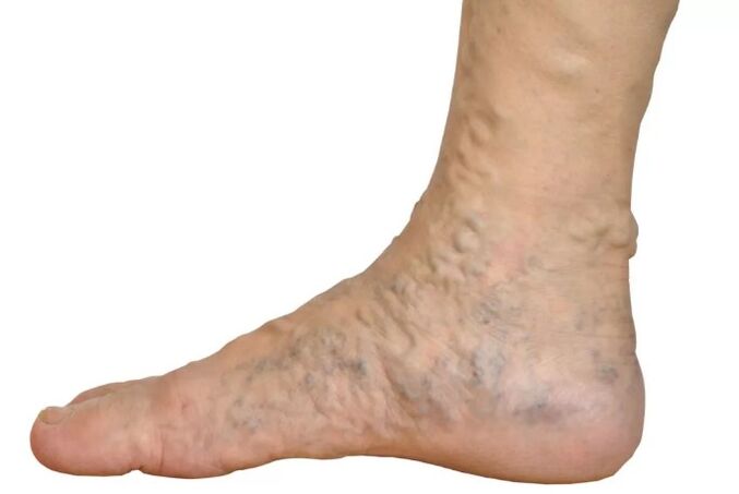 Veen Diseases sur les jambes