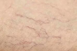 Étoiles vasculaires
