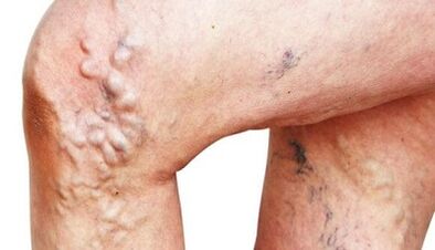 Les principales manifestations des varices dans les jambes