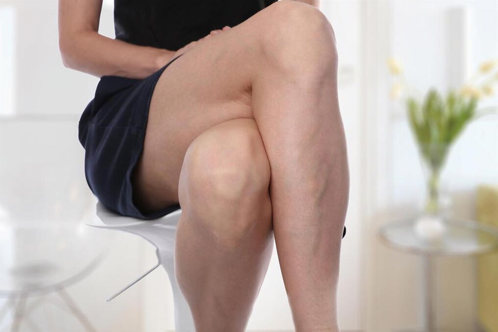 Varices chez une femme.