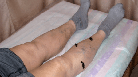 traitement des varices avec des sangsues