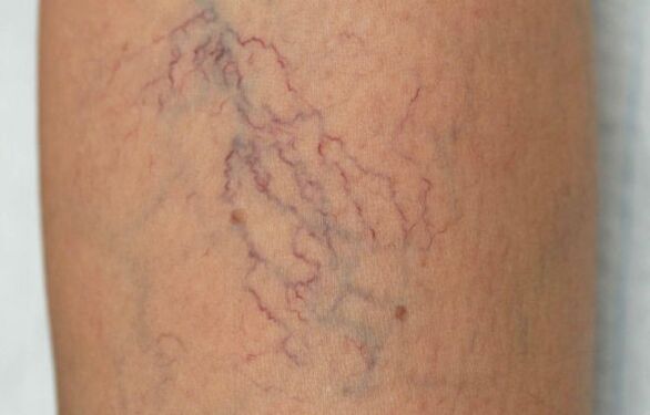 varices dans les jambes chez les femmes