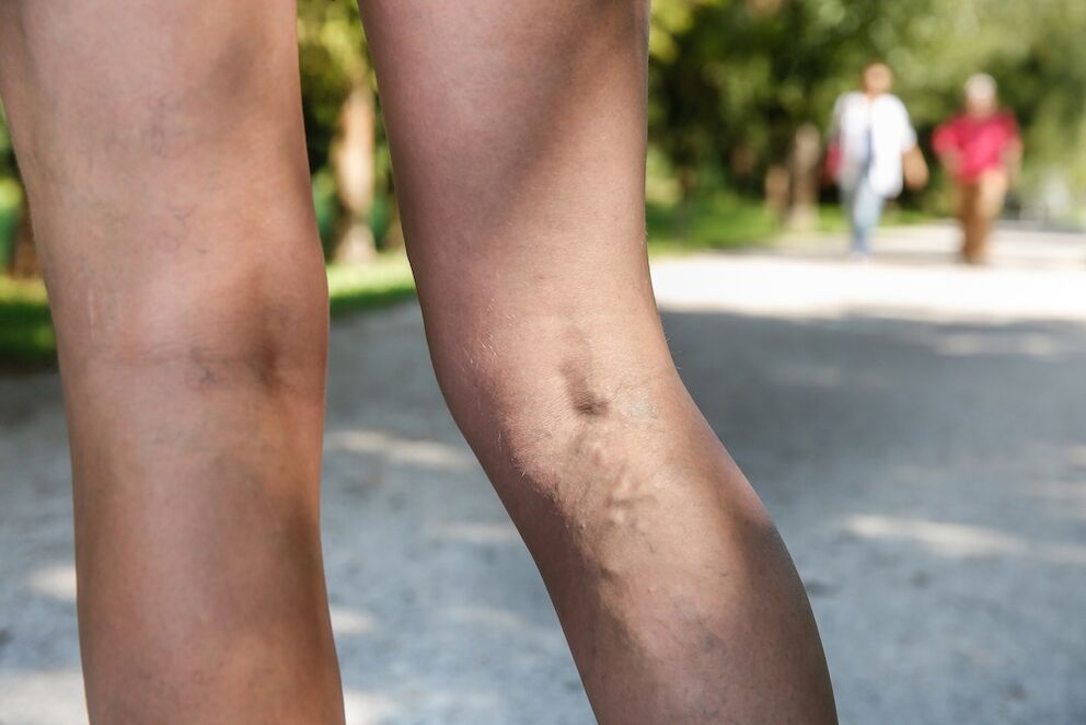 varices dans les jambes
