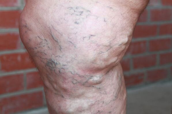 Signes de varices