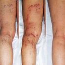 Varices des jambes.