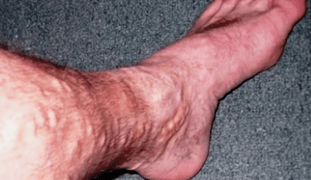 causes des varices dans les jambes chez les hommes