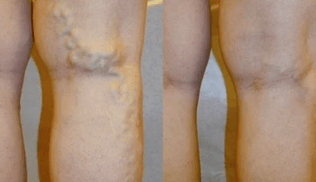signes et symptômes de varices dans les jambes chez les hommes