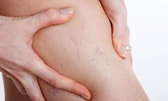 Raisons du développement des varices dans les jambes.