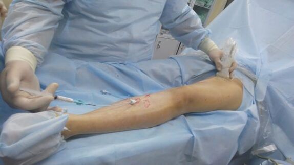 Chirurgie des varices des jambes. 