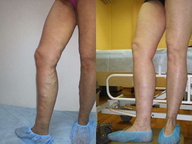 Jambes avant et après le traitement au laser des varices