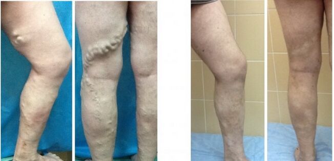 Jambes avant et après oblitération des veines avec varices par radiofréquence