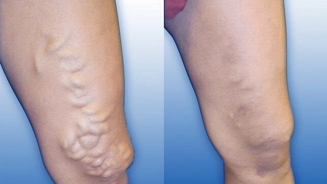 Jambes avant et après un traitement sévère des varices