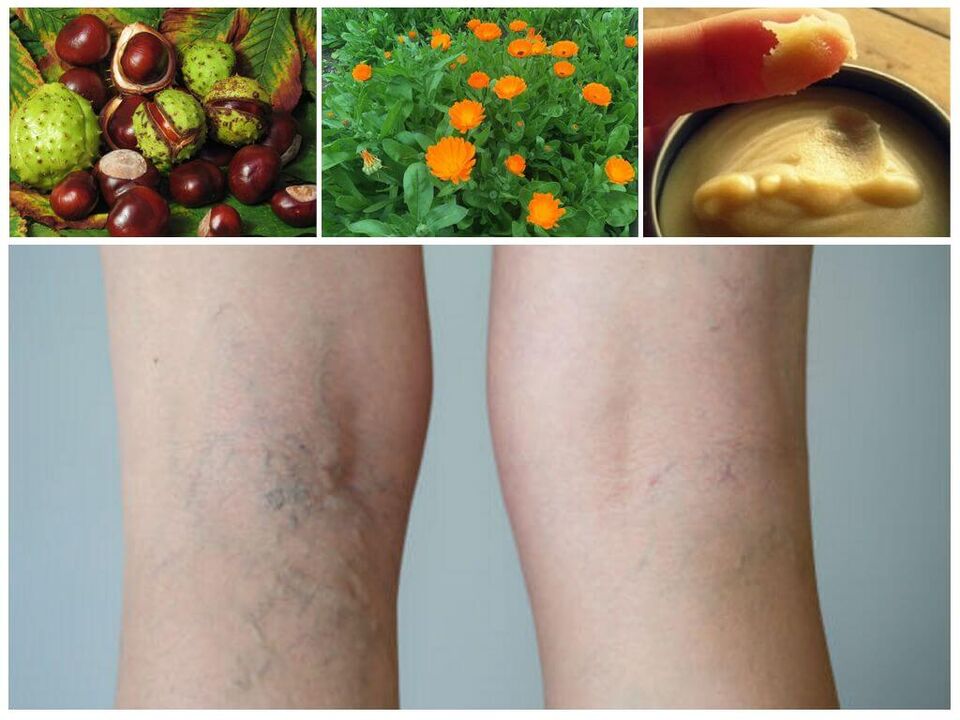 Les varices dans les jambes et les remèdes maison pour leur prévention. 