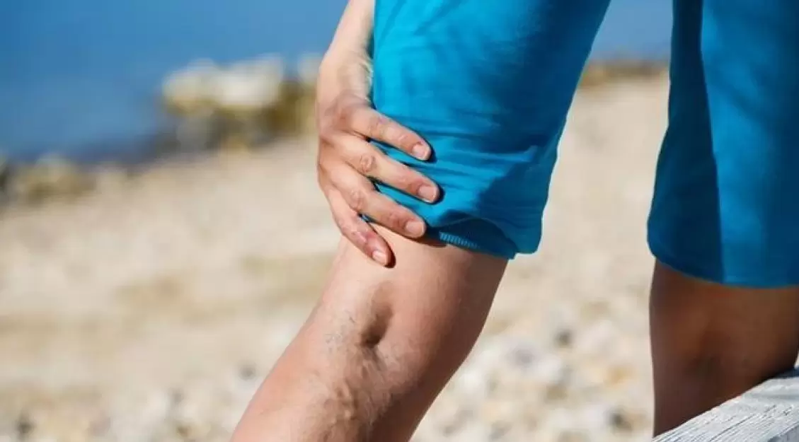 Les veines bleues bombées sur les jambes sont un signe de varices. 